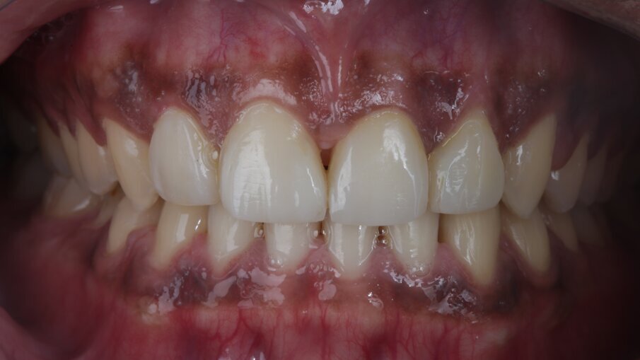 Fig 23: Post-op situation