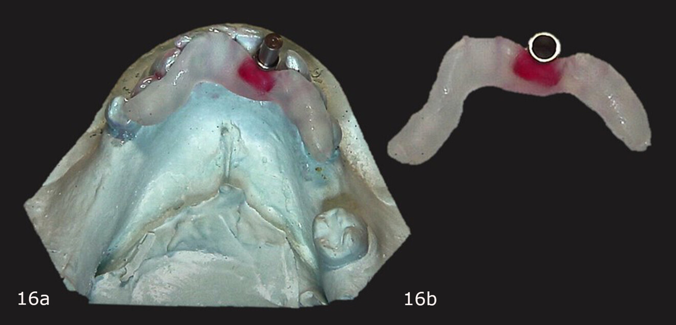 Figs. 16a & b: Primopattern LC Gel placed over the cleat and primosplint adapted to the cast (a). Corrected surgical guide after light polymerisation (b).