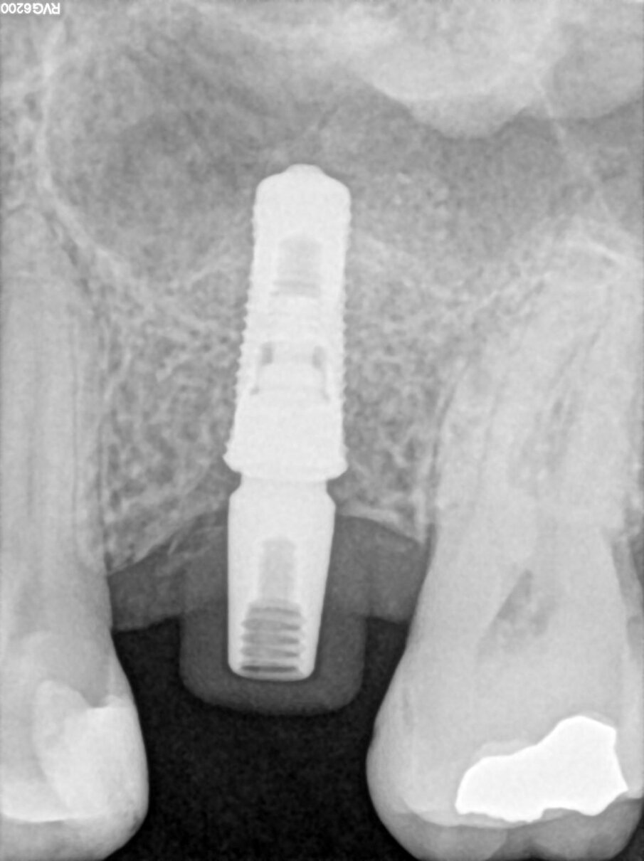 Fig. 7_Follow-up radiografico a 3 mesi.