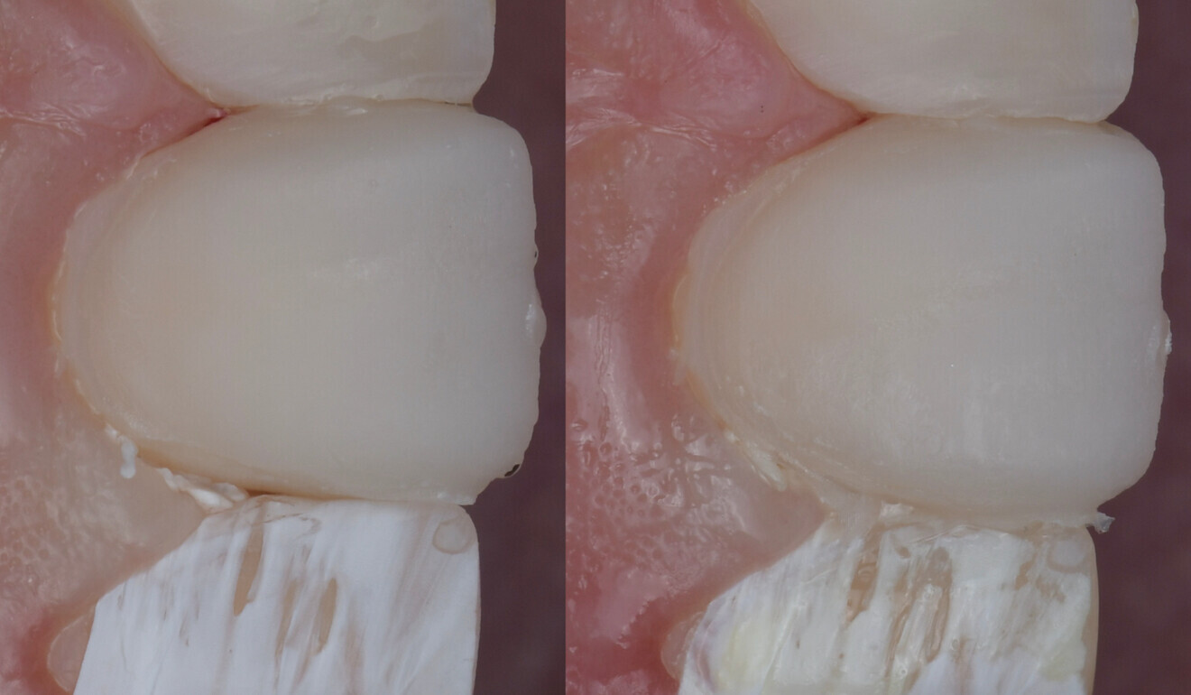 Fig. 15: Outcome of the flowable injection procedure prior to finishing and polishing.