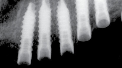 UIS IMPLADENTA – Use for all cases! Užití ve všech případech!