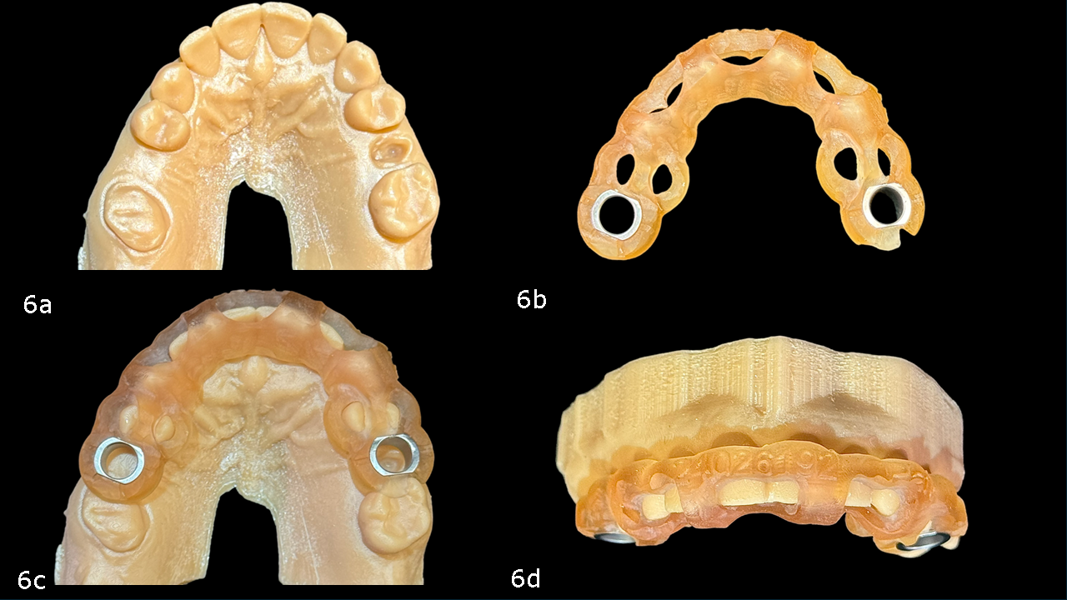 Figs. 6a–d: 3D-printed model and surgical guide.