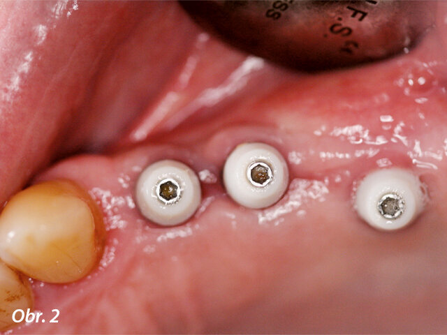 Po 4 měsících hojení bylo provedeno otiskování.