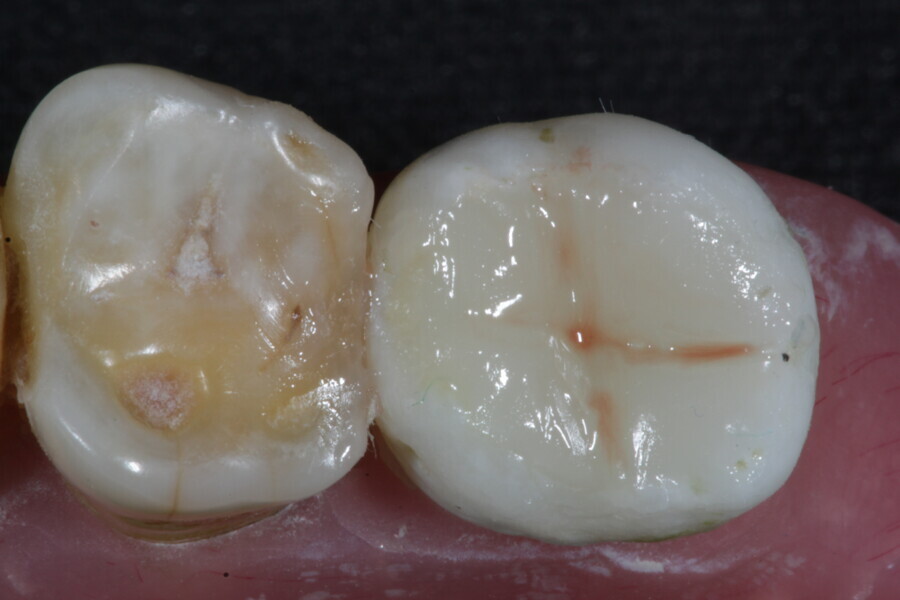 Fig. 32: The final occlusal layer of the restoration is placed using an enamel supra-nano hybrid composite in Shade A2 (Estelite).