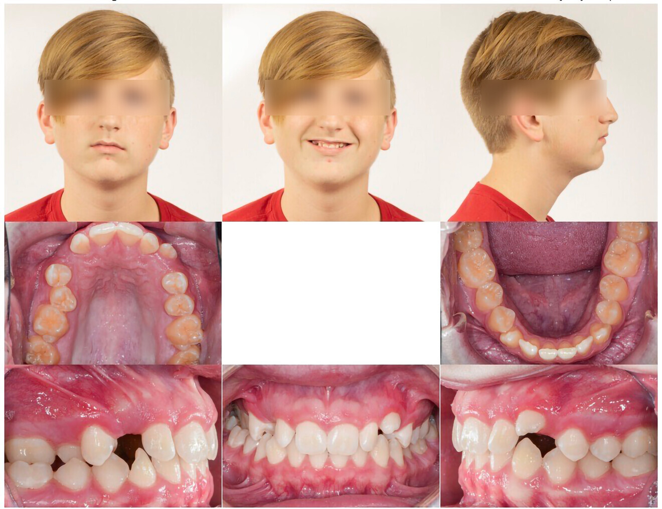 Figs. 2a–h: Initial photographs of a case involving an impacted maxillary right canine.