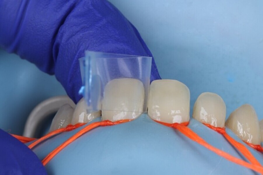 Fig. 3b: Clear matrix placement and stabilization with the liquid dam using injectable  composite.