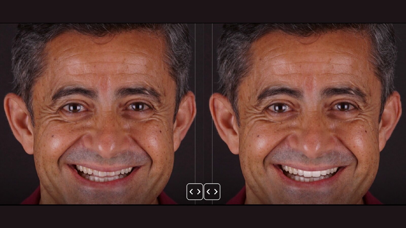 Colocación de restauraciones cerámicas adhesivas en la zona estética (1)