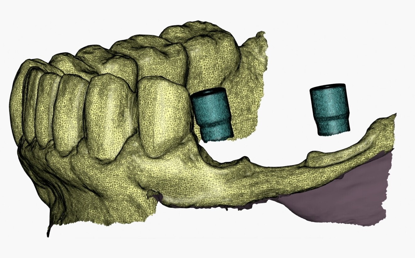 Figs. 2a & b:: Intra-oral scanning using ProCam scan bodies.