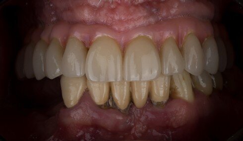 Nino po třech letech kouření - detail