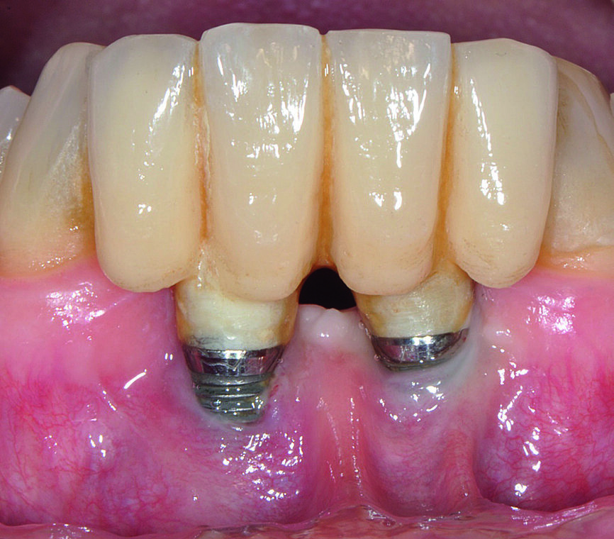 Fig. 6 : Une planification inappropriée a mené à un mauvais résultat.