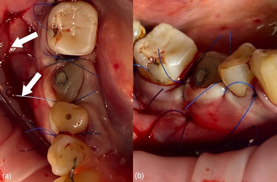 Fig. 15_a) e b) Strato intermedio (colore viola scuro) e strato superficiale (colore blu) di sutura monofilamento. Le frecce bianche indicano la posizione dell’incisione superficiale.