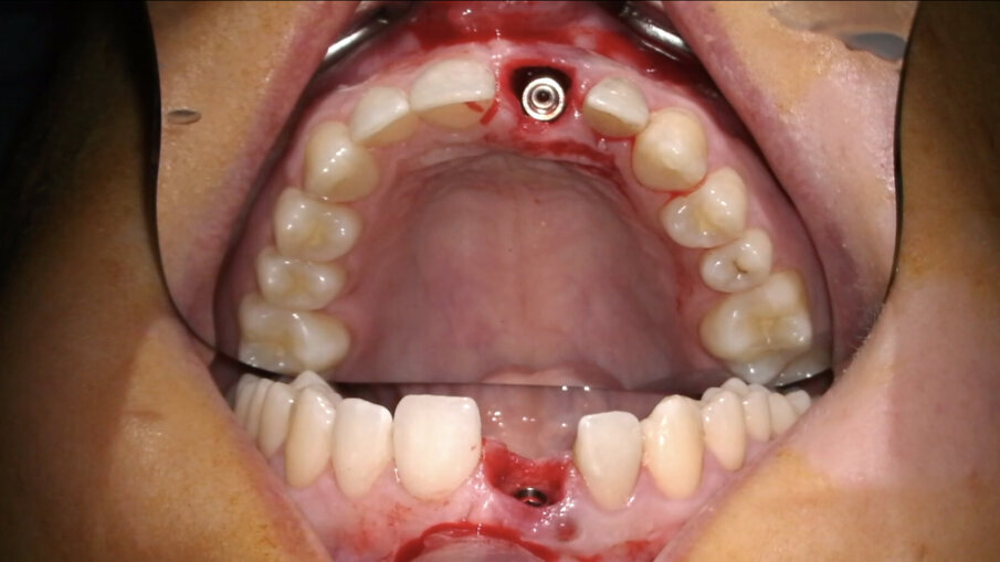 Fig. 17_Posizione corretta dell’impianto post-estrattivo.