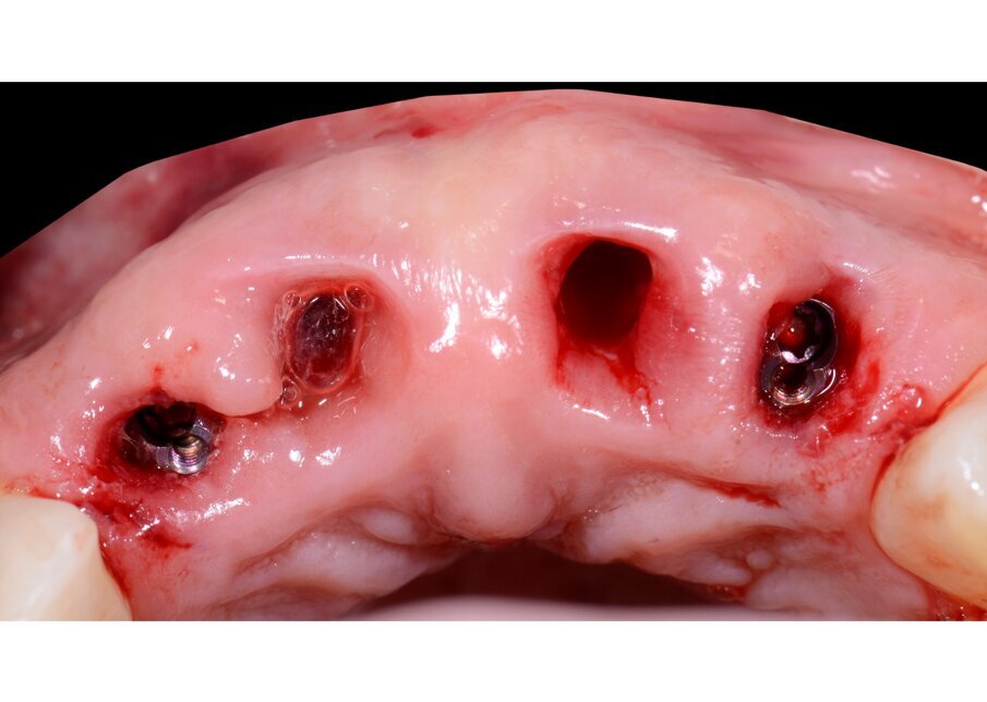 Fig. 63 - Visione occlusale dei monconi.