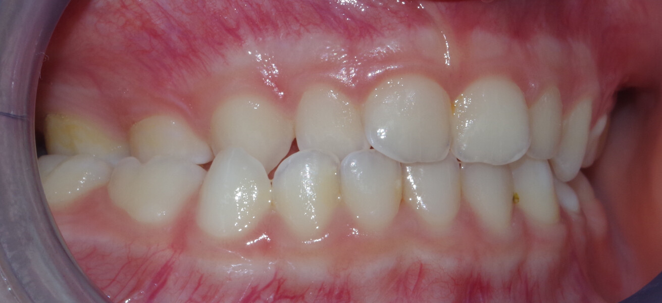 Fig. 13a: Initial intra-oral photograph: right lateral view.
