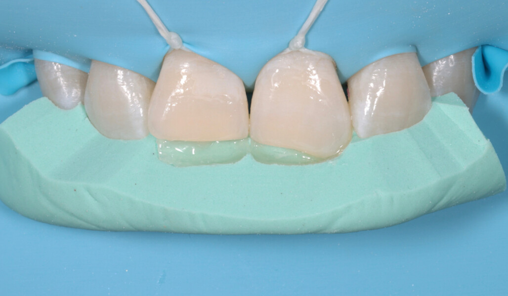 Fig. 9b: Silicone index filled with composite to build up the palatal shell.