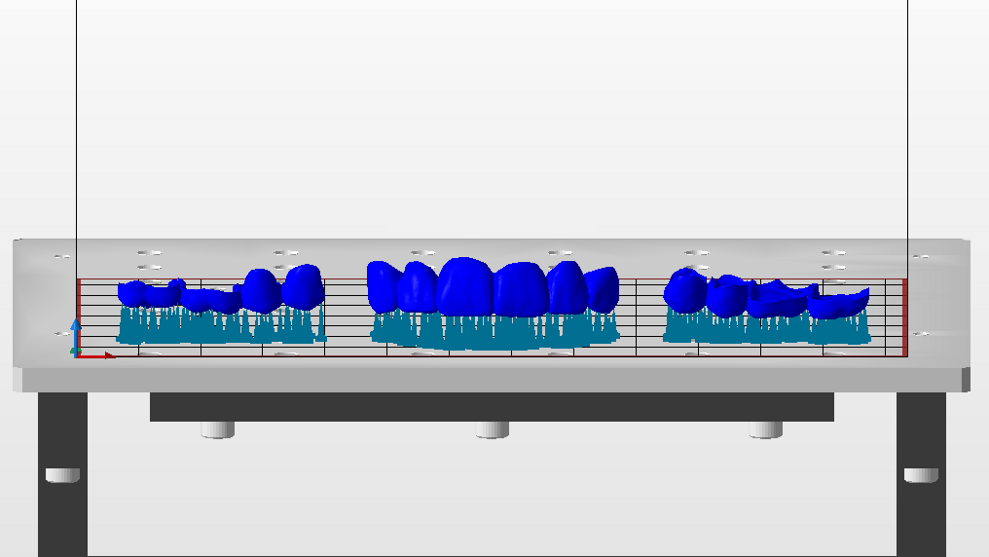 Fig. 8: Provisional restorations in the CAM software with supporting structures.