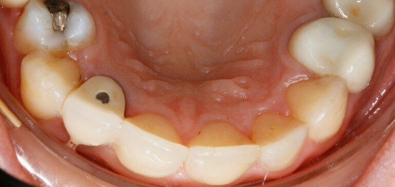 Fig. 4b - Controllo a tre mesi.