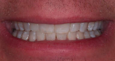 Principi biomimetici applicati all’odontoiatria cosmetica