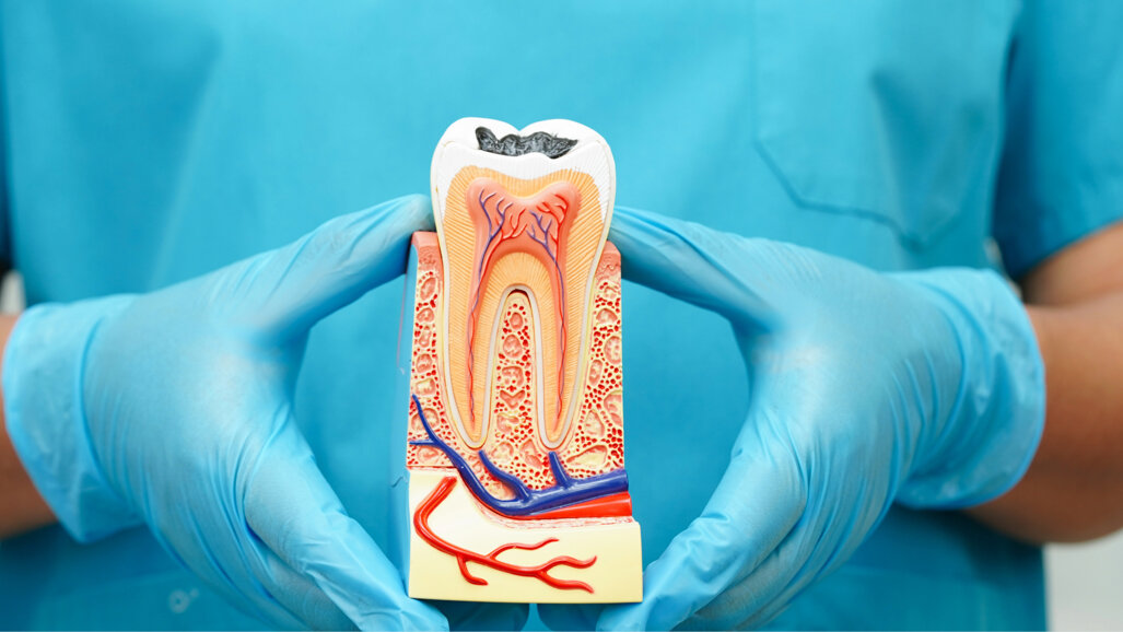 Therapeutic pulpotomy emerging as an alternative to root canal therapy