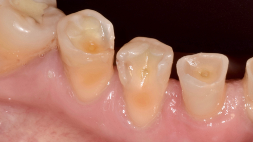 Fig. 2: Large areas of cervical loss of enamel due to powerful phenomena of abrasion and erosion of enamel and high dentine hypersensitivity pain.
