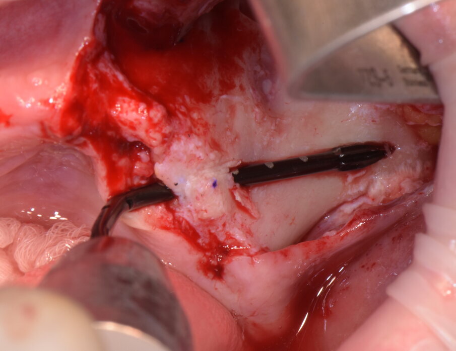 Figg. 11-14 - Preparazione finale.