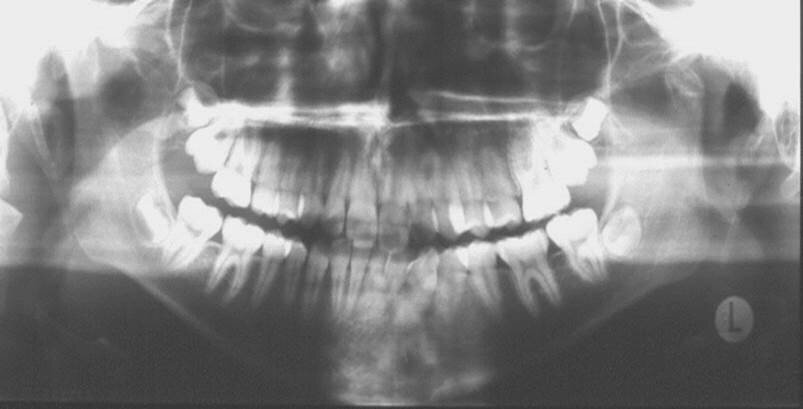 Figure 4. Panoramic radiograph of a 15-year-old girl showing fracture of the left condyle.