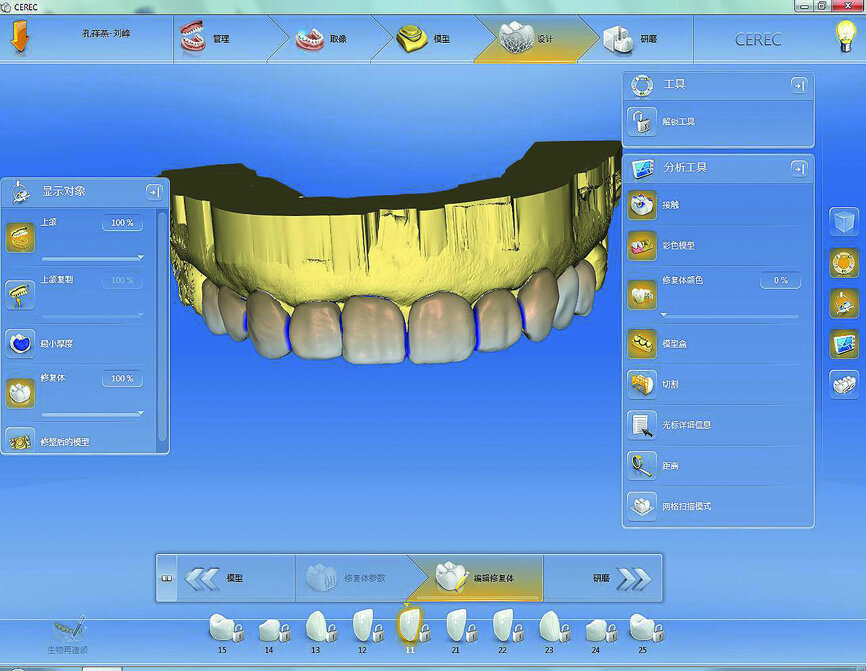 Fig. 17: Finished restoration design.