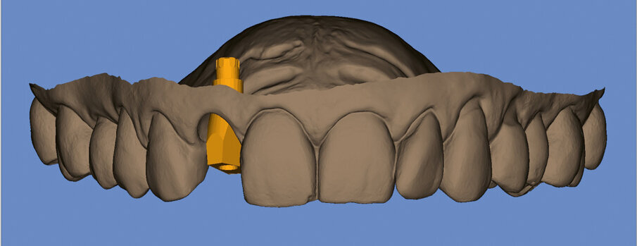 Fig. 6. Surface scan of the preoperative situation