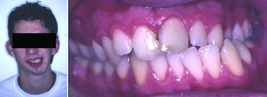 Figure 5. Facial photograph of a 16-year-old boy with osseous ankylosis of the left TMJ. The discrepancies include severe asymmetries in the mandibular body and ramus (a). Malocclusion is characterized by left anterior and posterior crossbite, tilting of the occlusal plane, and lower dental midline deviation to the affected side (b). 