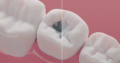 Northern Ireland exempt from EU dental amalgam ban