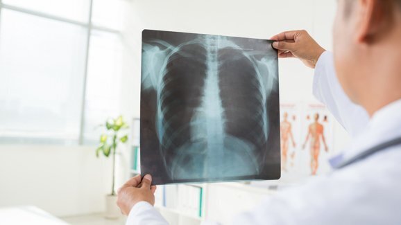 Tratamento da cárie pode prevenir pneumonia em pacientes com Parkinson