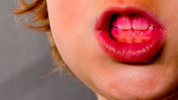 Il grafene rallenta la carie e la malattia parodontale