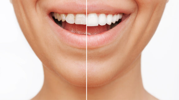 Adhesives influence colour stability of composite veneers