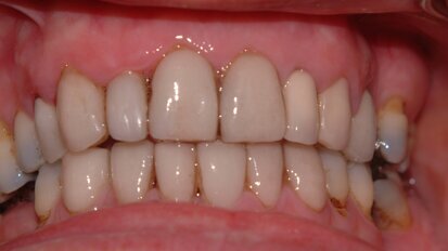 Porcelain Laminate Veneers – Avoiding Complications