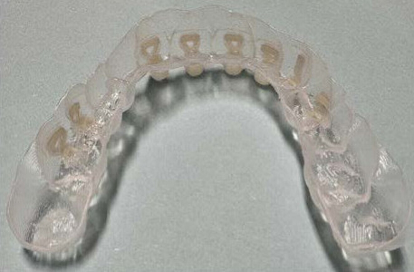 Figs. 5a & b: Clarity Aligners Precision Grip Attachments in the attachment tray.