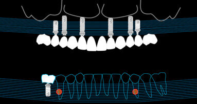 Riabilitazione implanto-protesica di un caso complesso alla luce delle nuove tecnologie: un caso clinico