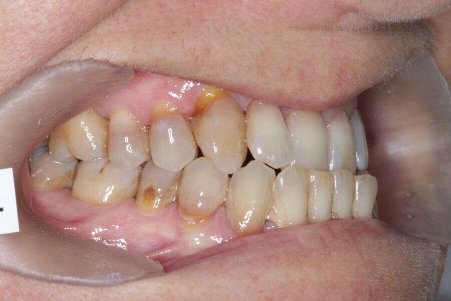 Fig. 28: Initial situation. Class III malocclusion patient.