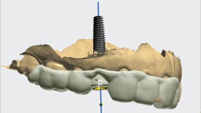 Clinical digital workflows for implant crowns