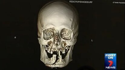 Succesvolle gezichtsreconstructie na ongeluk met kettingzaag