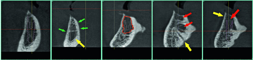 Fig. 10: The cross-sectional slices revealing ‘hollow’ areas in the symphysis.