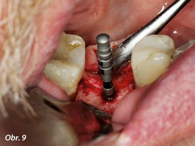 3D pozice ověřena paralelizačním pinem, laterální pohled.