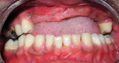 Future: Loose a tooth, grow a tooth with stem cells