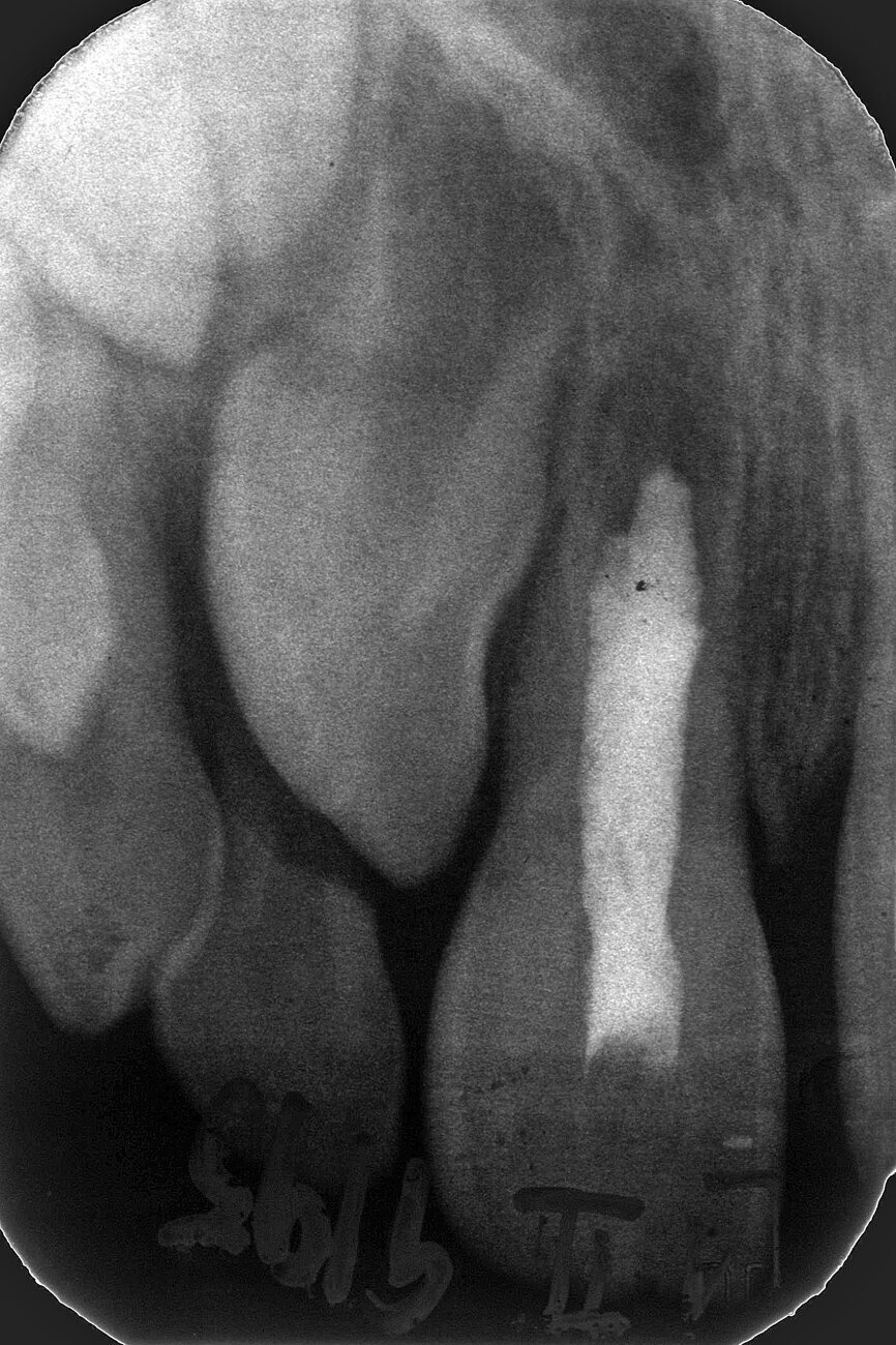 Case 3: Female (born 8 August 1988): Tooth 11
Fig. 5b: 4 September 1995 post RCF
