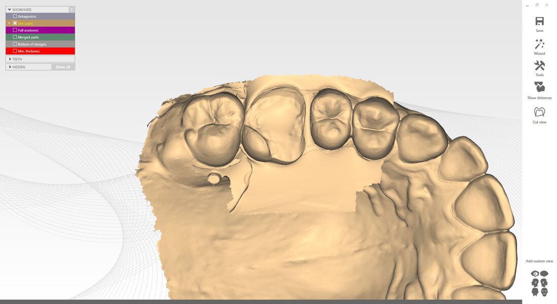 Fig. 17a: Digital workflow for the onlay design. Intra-oral scan imported into the design software.
