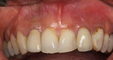 Cirugía periapical y regeneración ósea para un defecto apicomarginal en la zona estética