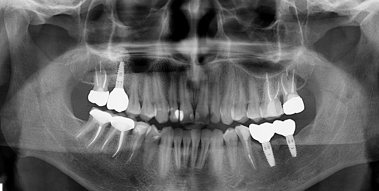 Fig. 22 : Radiographie  prise  en 2022.