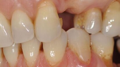 Pogrubienie dziąsła zrogowaciałego w odcinku estetycznym w leczeniu implantologicznym