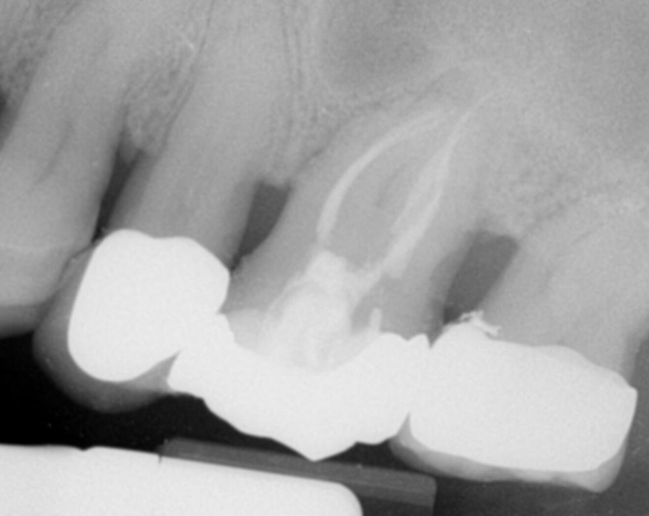 Fig. 8: Post-op radiograph of the root canal treatment done using Adaptive Motion with the narrow canal file sequence.