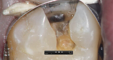 The dental microscope for general dentistry