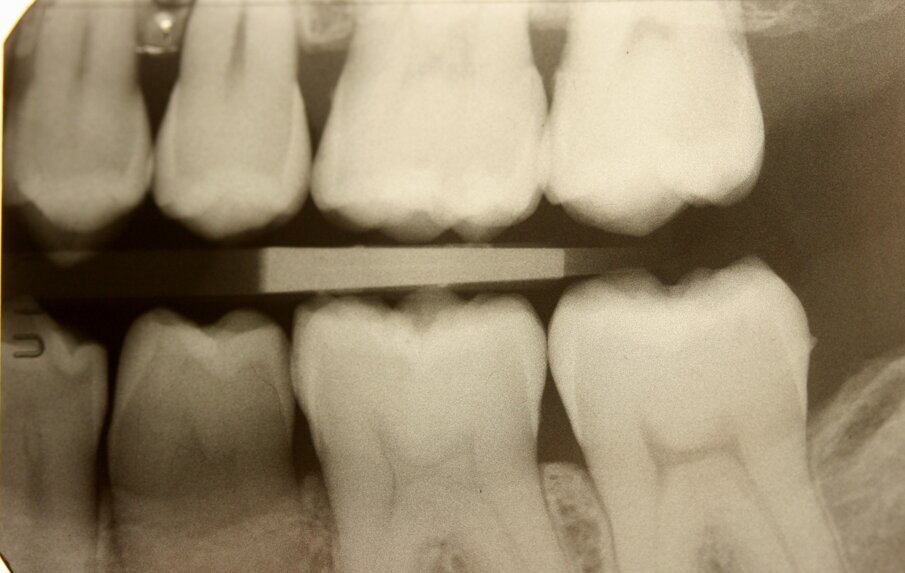 Fig. 4_Bite-wing di sinistra.